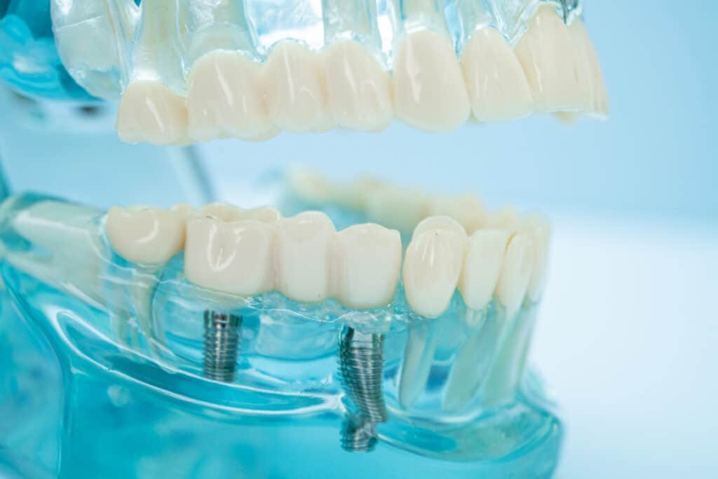 All‑on‑4 dental implant system for full‑arch tooth replacement