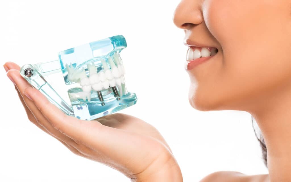 All‑on‑6 dental implant system providing full‑arch tooth replacement