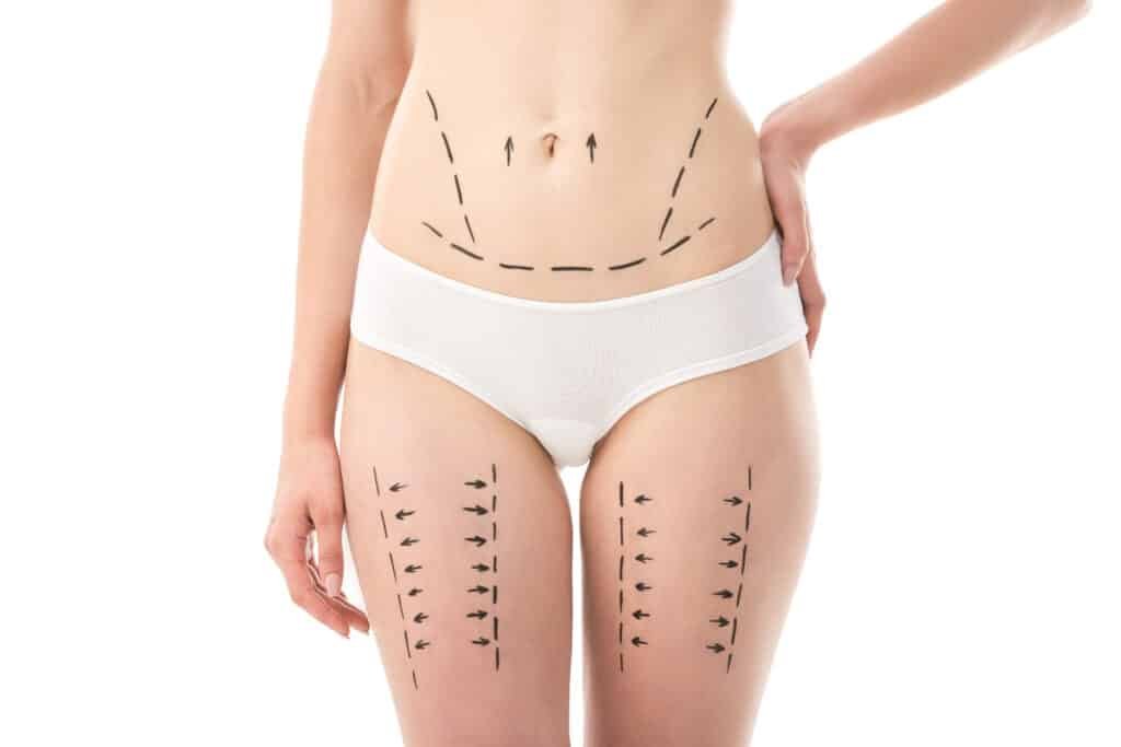 Post‑weight‑loss body contouring addressing sagging skin and irregularities