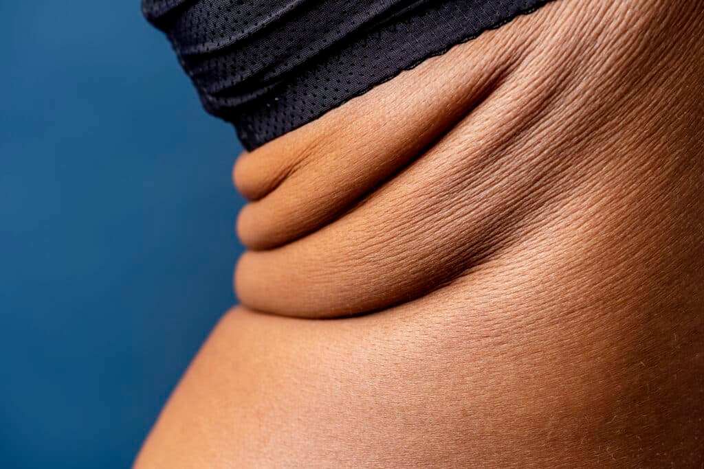Bra bulge contouring procedures addressing upper back localized fat and sagging skin