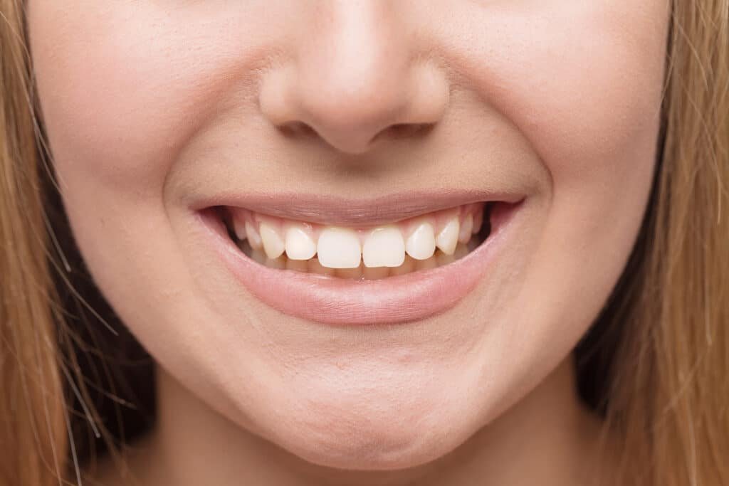 Composite veneer using tooth‑colored resin for minor shape and color correction