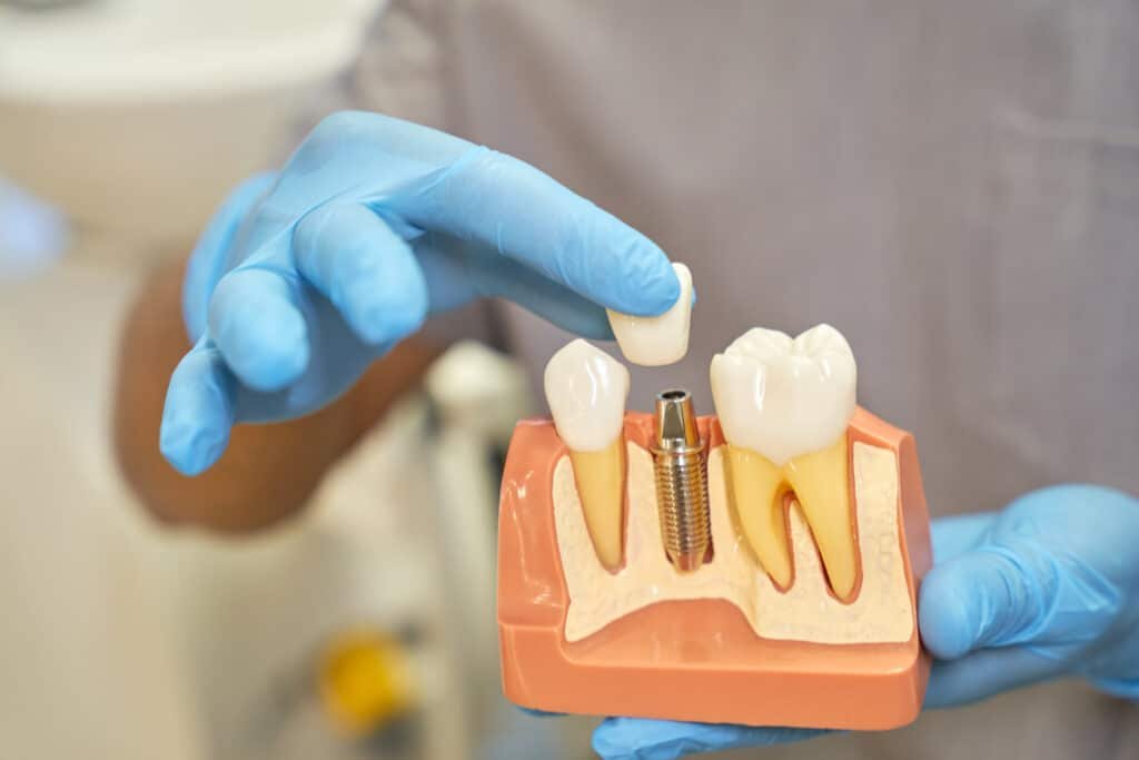 Dental implants using titanium for tooth and root replacement