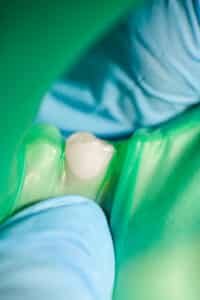Emax crown dental restoration with metal‑free natural translucency