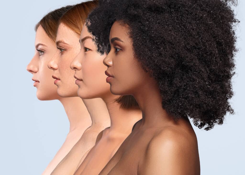 Ethnic rhinoplasty focusing on natural facial balance