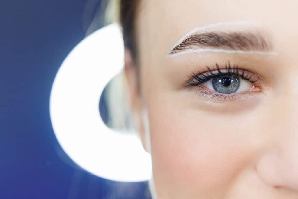 Female eyebrow implantation restoring shape, symmetry, and density