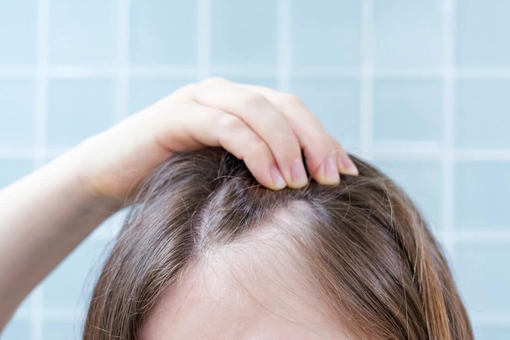 Localized Scalp Hair Loss Female Bold Spots