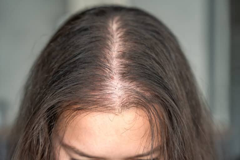 Female part line thinning hair implantation restoring density and coverage