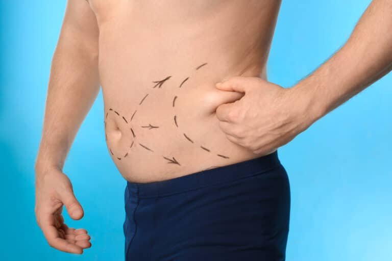 Liposuction for localized fat reduction in areas commonly associated with male anatomy