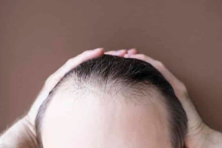 Male hairline implantation redefining the frontal hairline