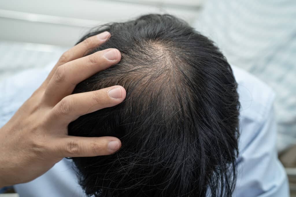 Male hair implantation addressing thinning spots and crown for hair restoration