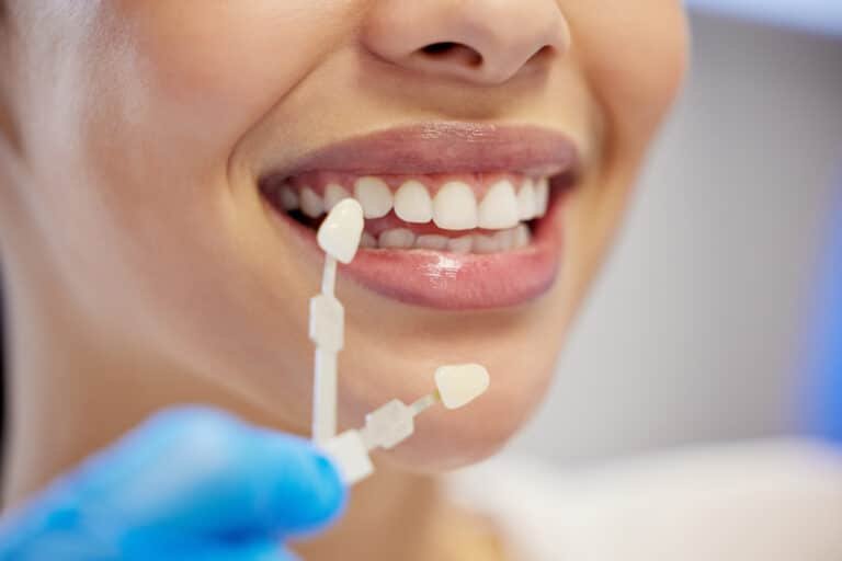 Porcelain veneers covering front teeth for natural smile enhancement
