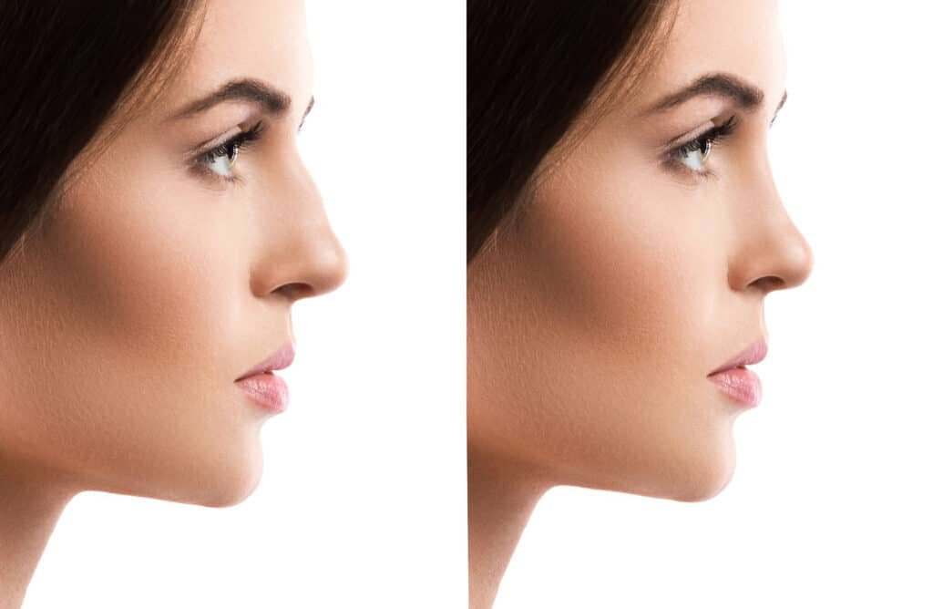 Rhinoplasty (Nose Surgery) in Turkey offering options for reshaping and improving the nasal structure for functionality and aesthetics.