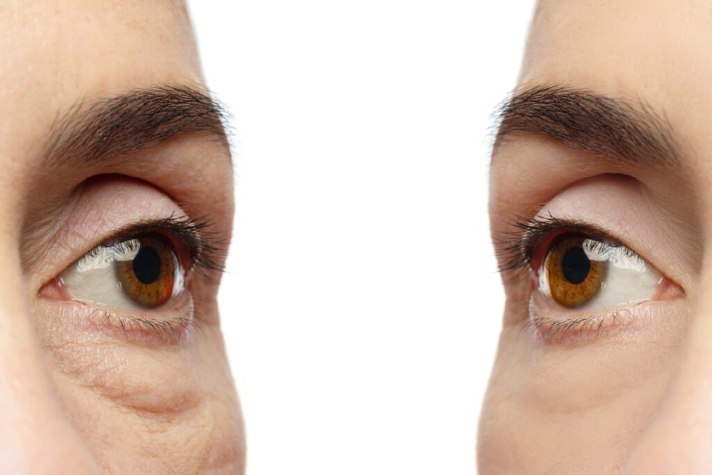 Under-eye aesthetics targeting bags and dark circles through laser treatments and specialized liposuction.