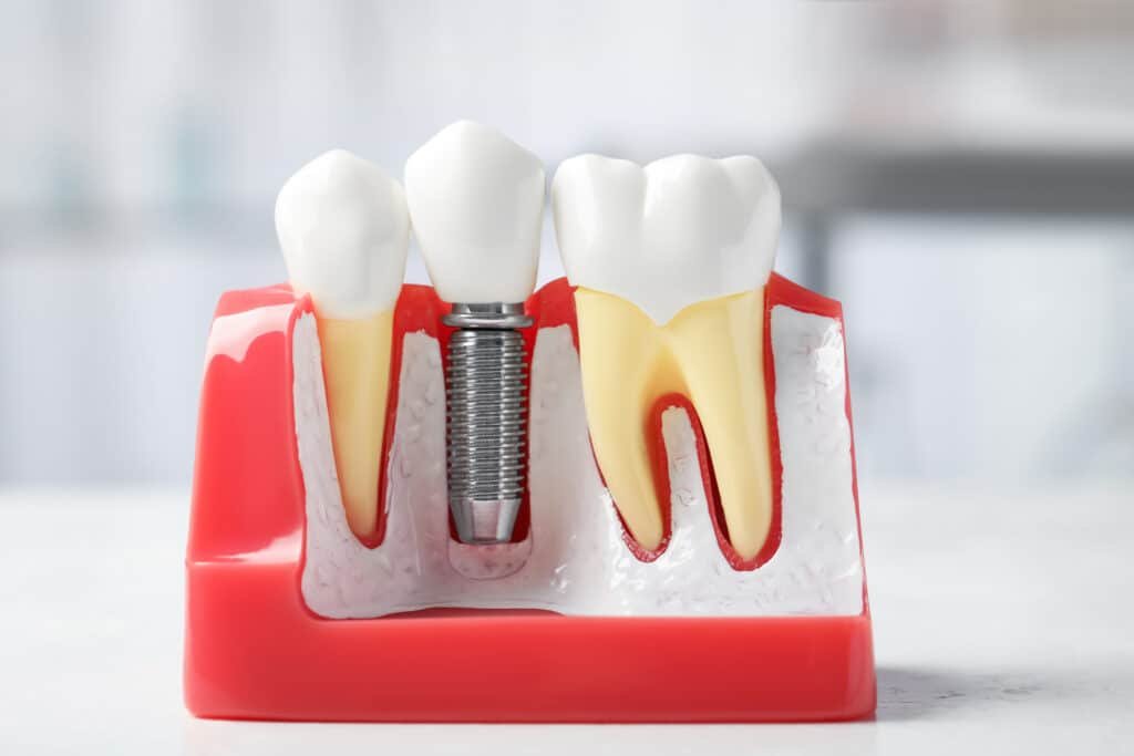 Zirconium crown dental restoration with strength and natural appearance