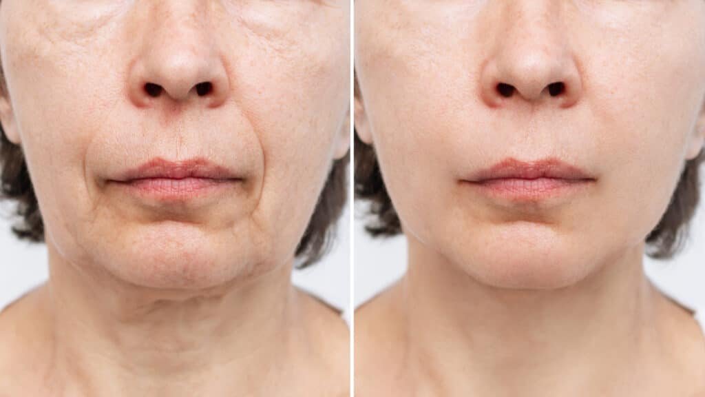 Smile Marionette Line Treatment Planning