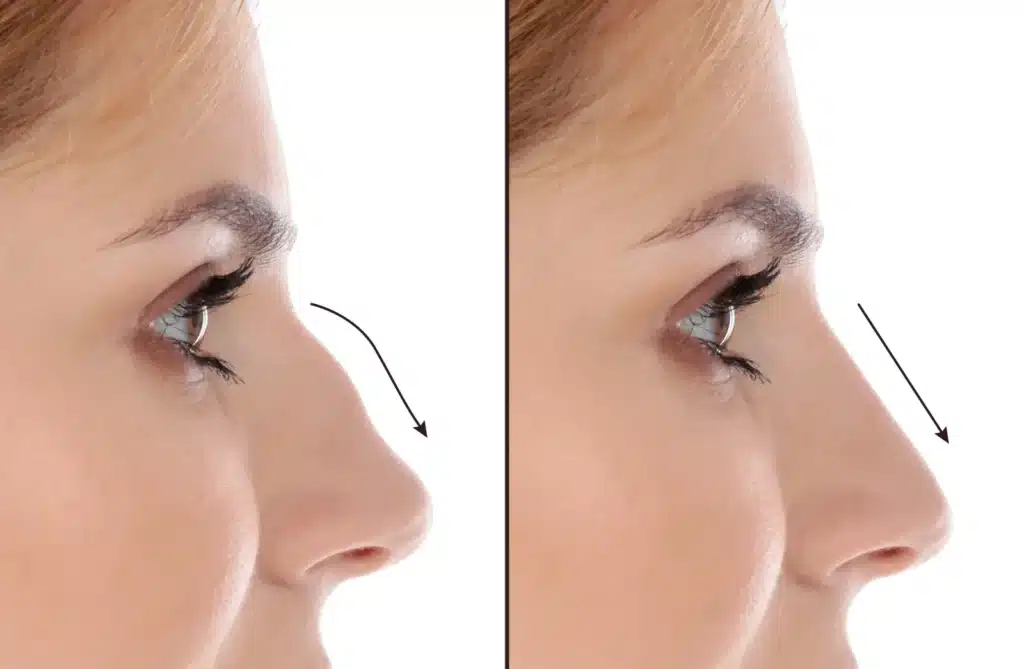 Nose Correction Turkey