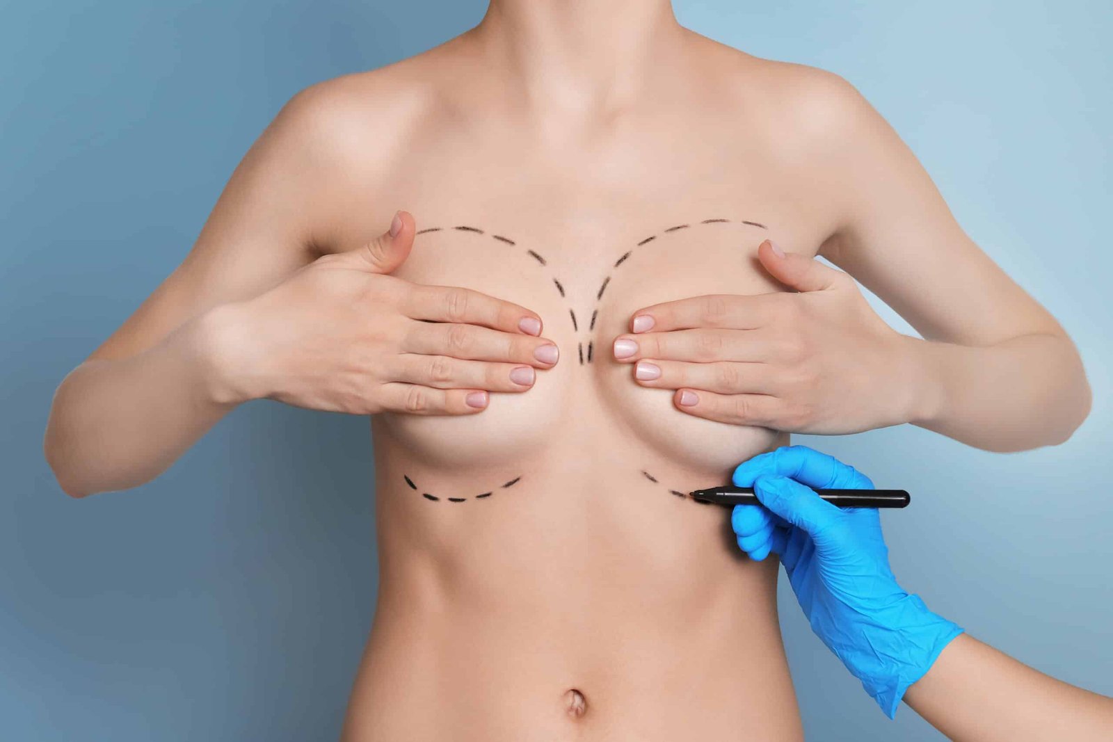Breast Augmentation Planning Image
