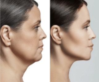 Chin tuck aesthetic procedures addressing contour irregularities, chin positioning, and jawline correction.