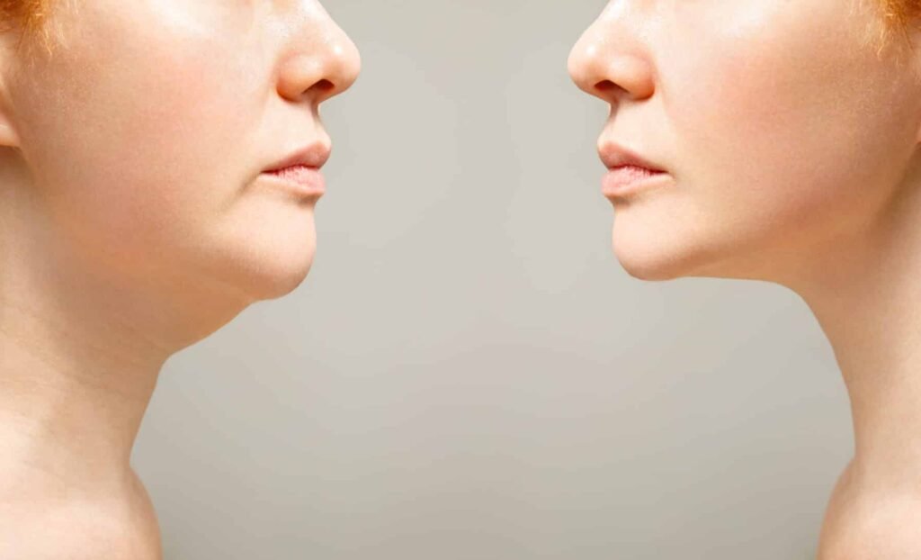 Double chin and localized fat deposits addressed through neck liposuction.