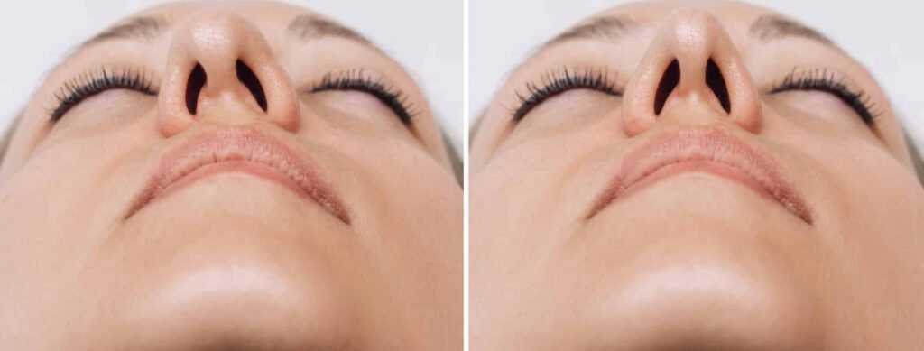 Functional Nose Surgery, Rhinoplasty, Improved Breathing and Symmetry