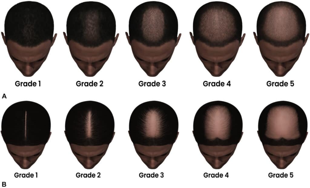 Hair implantation in Turkey tailored for male and female hair loss patterns including DHI and Sapphire FUE