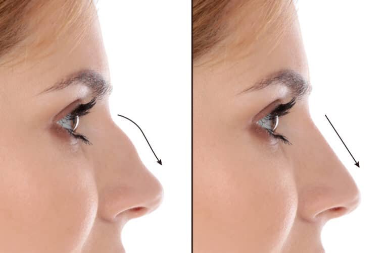 Nasal bridge straightening addressing crooked nose, dorsal hump irregularities.
